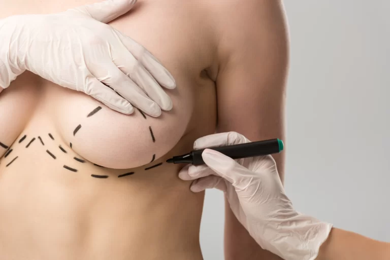 Things to Expect After a Breast Augmentation Surgery - - beautyful girl